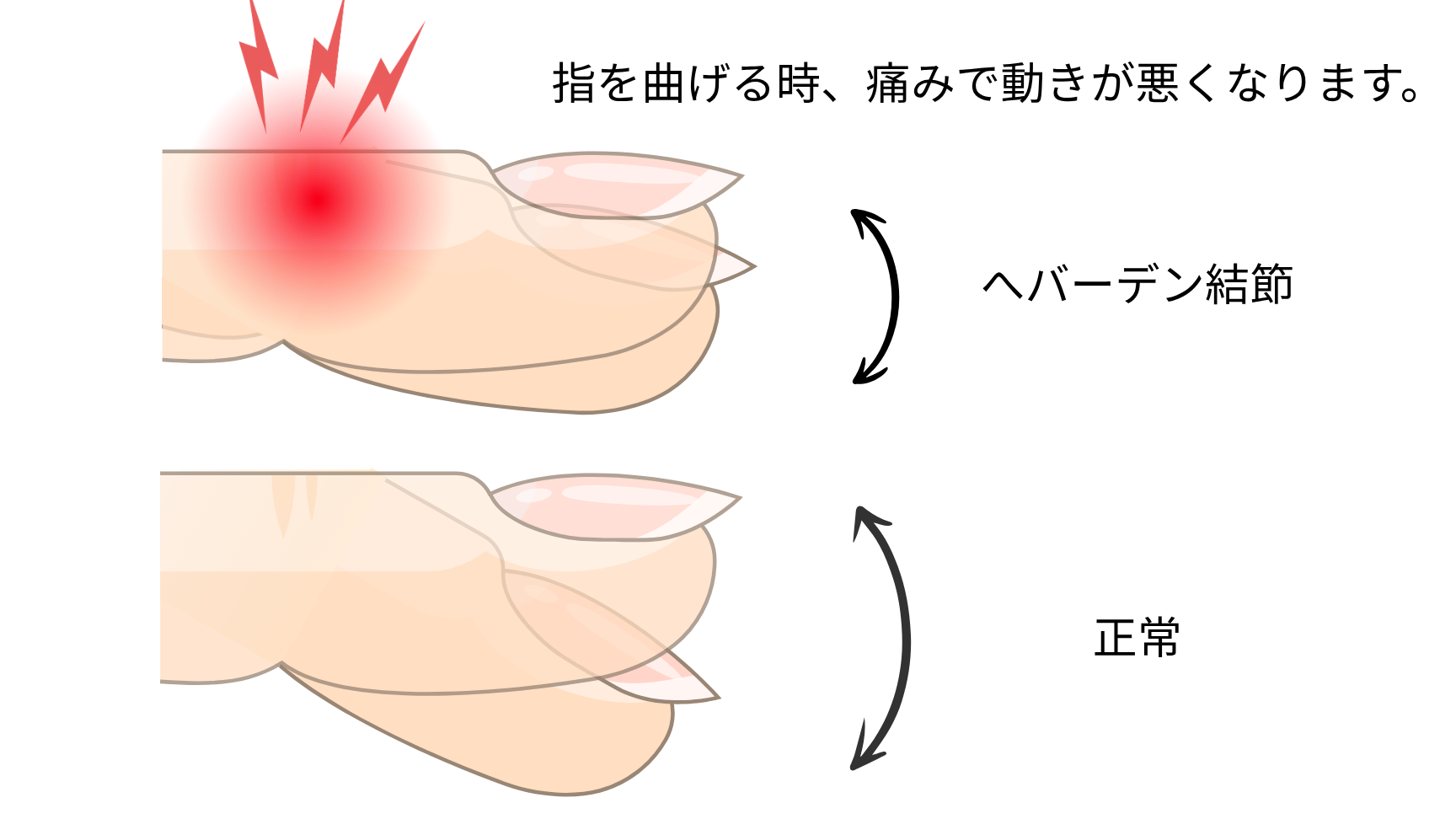 ushio-sekkotu-heberden_03