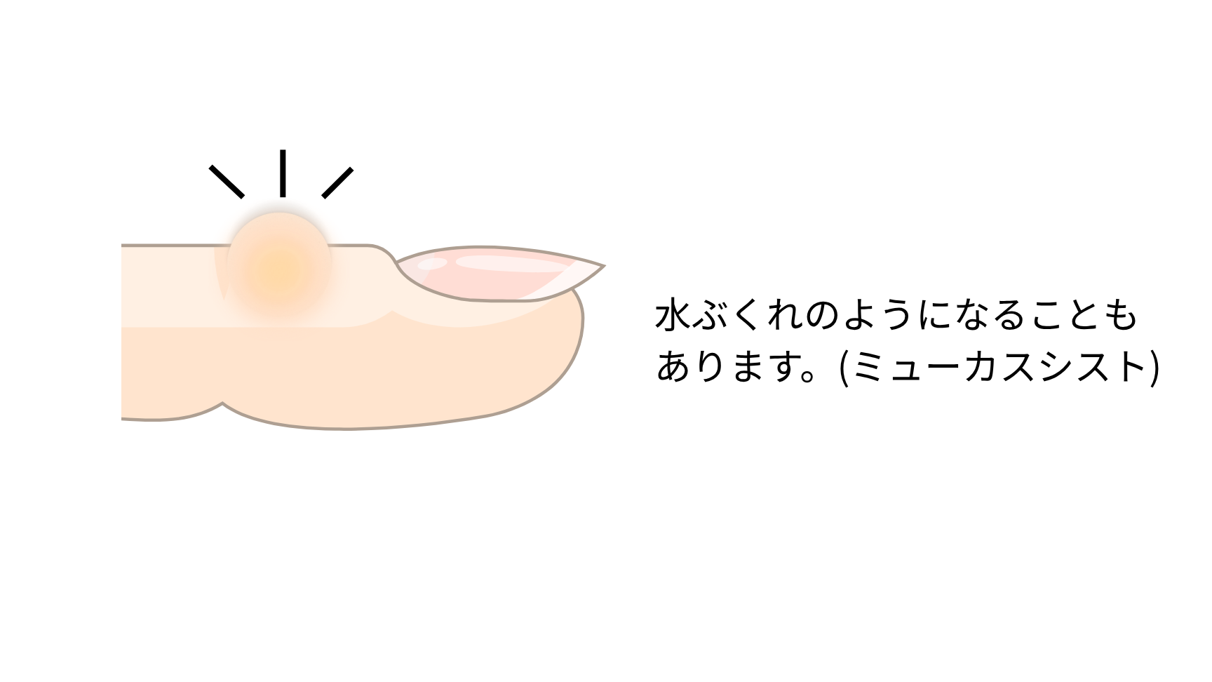 ushio-sekkotu-heberden_04