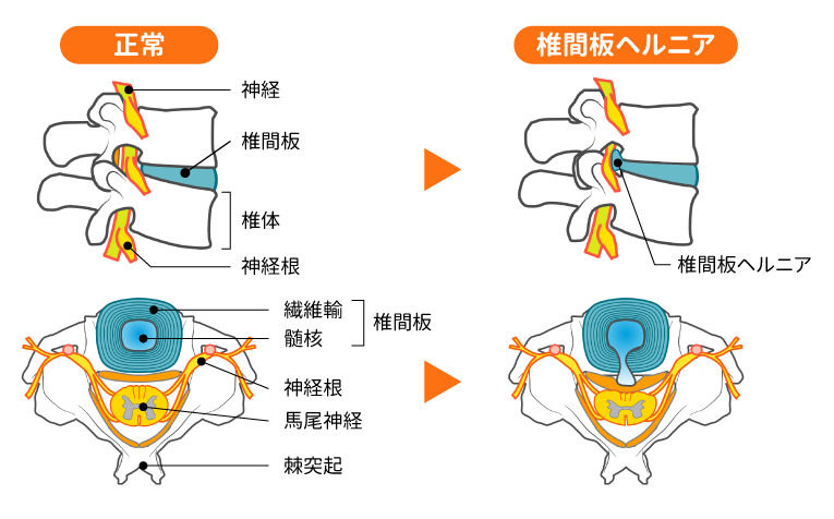 ushio-sekkotu-herniaー condition