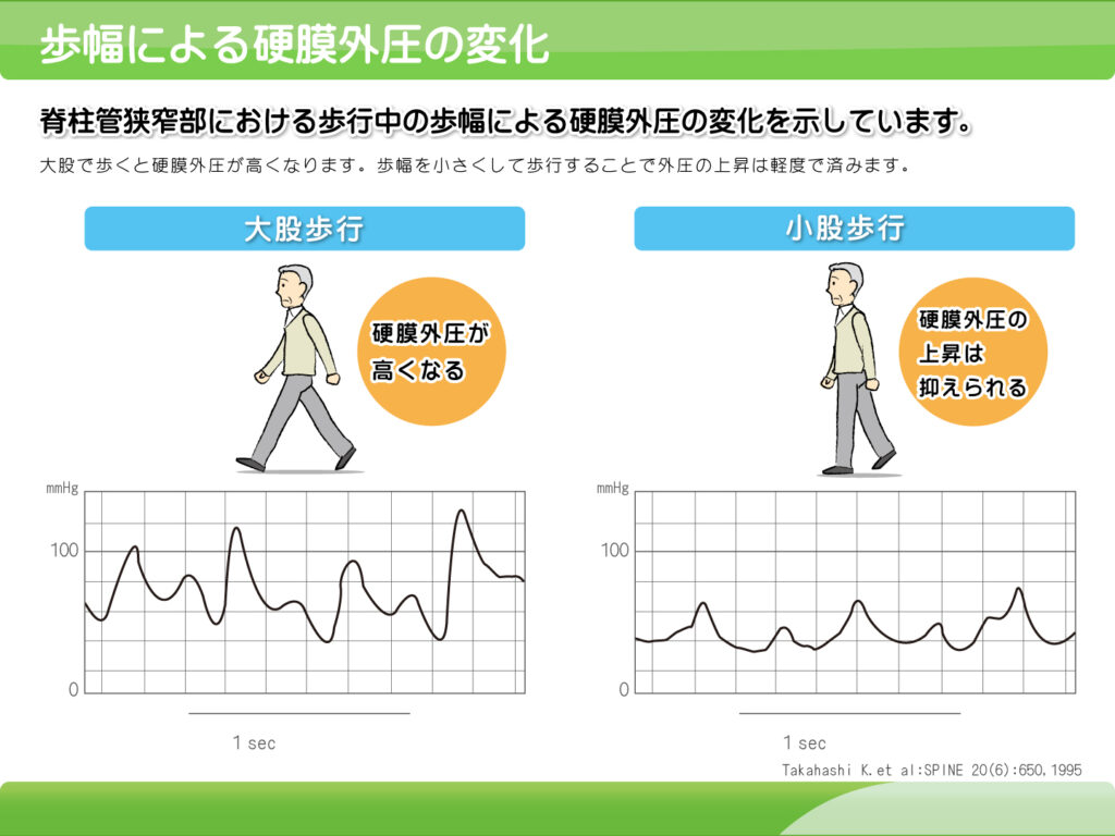 ushi-sekkotu-changes due to stride length